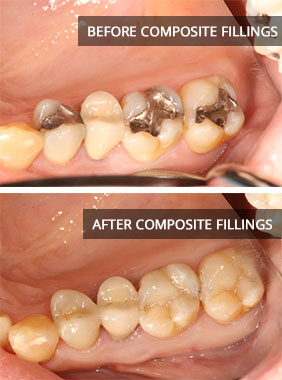Composite Filling Before & After Photos