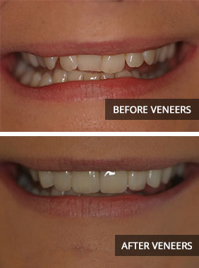 veneers before and after